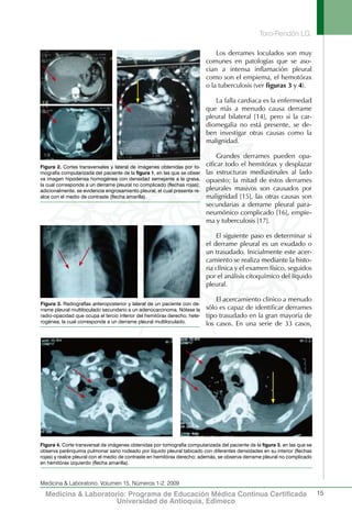 Toro-Rendón LG.
15
Medicina & Laboratorio, Volumen 15, Números 1-2, 2009
Medicina & Laboratorio: Programa de Educación Médica Contínua Certificada
Universidad de Antioquia, Edimeco
Los derrames loculados son muy
comunes en patologías que se aso-
cian a intensa inflamación pleural
como son el empiema, el hemotórax
o la tuberculosis (ver figuras 3 y 4).
La falla cardiaca es la enfermedad
que más a menudo causa derrame
pleural bilateral [14], pero si la car-
diomegalia no está presente, se de-
ben investigar otras causas como la
malignidad.
Grandes derrames pueden opa-
cificar todo el hemitórax y desplazar
las estructuras mediastinales al lado
opuesto; la mitad de estos derrames
pleurales masivos son causados por
malignidad [15], las otras causas son
secundarias a derrame pleural para-
neumónico complicado [16], empie-
ma y tuberculosis [17].
El siguiente paso es determinar si
el derrame pleural es un exudado o
un trasudado. Inicialmente este acer-
camiento se realiza mediante la histo-
ria clínica y el examen físico, seguidos
por el análisis citoquímico del líquido
pleural.
El acercamiento clínico a menudo
sólo es capaz de identificar derrames
tipo trasudado en la gran mayoría de
los casos. En una serie de 33 casos,
Figura 2. Cortes transversales y lateral de imágenes obtenidas por to-
mografía computarizada del paciente de la figura 1, en las que se obser
va imagen hipodensa homogénea con densidad semejante a la grasa,
la cual corresponde a un derrame pleural no complicado (flechas rojas);
adicionalmente, se evidencia engrosamiento pleural, el cual presenta re-
alce con el medio de contraste (flecha amarilla).
Figura 3. Radiografías anteroposterior y lateral de un paciente con de-
rrame pleural multiloculado secundario a un adenocarcinoma. Nótese la
radio-opacidad que ocupa el tercio inferior del hemitórax derecho, hete-
rogénea, la cual corresponde a un derrame pleural multiloculado.
Figura 4. Corte transversal de imágenes obtenidas por tomografía computarizada del paciente de la figura 3, en las que se
observa parénquima pulmonar sano rodeado por líquido pleural tabicado con diferentes densidades en su interior (flechas
rojas) y realce pleural con el medio de contraste en hemitórax derecho; además, se observa derrame pleural no complicado
en hemitórax izquierdo (flecha amarilla).
 