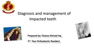 Diagnosis and management of
Impacted teeth
Prepared by: Osama Ahmad haj
3rd Year Orthodontic Resident
 