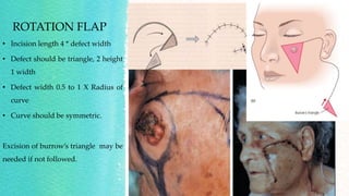 Local and regional flaps in head and neck.pptx