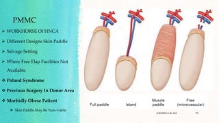 Skin Paddle Incision Local and regional flaps in head and neck.pptx