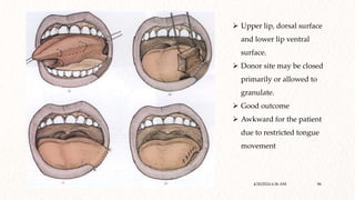 Local and regional flaps in head and neck.pptx