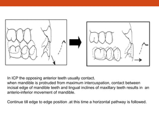 In ICP the opposing anterior teeth usually contact.
when mandible is protruded from maximum intercuspation, contact between
incisal edge of mandible teeth and lingual inclines of maxillary teeth results in an
anterio-inferior movement of mandible.
Continue till edge to edge position .at this time a horizontal pathway is followed.
 