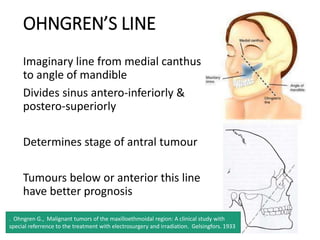 OHNGREN’S LINE
Imaginary line from medial canthus
to angle of mandible
Divides sinus antero-inferiorly &
postero-superiorly
Determines stage of antral tumour
Tumours below or anterior this line
have better prognosis
. Ohngren G., Malignant tumors of the maxilloethmoidal region: A clinical study with
special referrence to the treatment with electrosurgery and irradiation. Gelsingfors. 1933
 