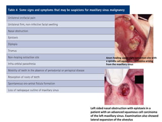 Anon-healing upper right extraction site with
a spindle cell squamous carcinoma arising
from the maxillary sinus
Left sided nasal obstruction with epistaxis in a
patient with an advanced squamous cell carcinoma
of the left maxillary sinus. Examination also showed
lateral expansion of the alveolus
 
