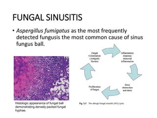 FUNGAL SINUSITIS
• Aspergillus fumigatus as the most frequently
detected fungusis the most common cause of sinus
fungus ball.
Histologic appearance of fungal ball
demonstrating densely packed fungal
hyphae.
 