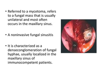 • Referred to a mycetoma, refers
to a fungal mass that is usually
unilateral and most often
occurs in the maxillary sinus.
• A noninvasive fungal sinusitis
• It is characterized as a
denseconglomeration of fungal
hyphae, usually localized in the
maxillary sinus of
immunocompetent patients.
 