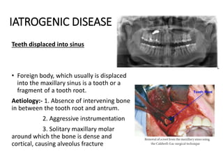 IATROGENIC DISEASE
Teeth displaced into sinus
• Foreign body, which usually is displaced
into the maxillary sinus is a tooth or a
fragment of a tooth root.
Aetiology:- 1. Absence of intervening bone
in between the tooth root and antrum.
2. Aggressive instrumentation
3. Solitary maxillary molar
around which the bone is dense and
cortical, causing alveolus fracture
 