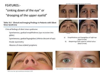 FEATURES:-
“sinking down of the eye” or
“drooping of the upper eyelid”
a) Enophthalmos and hypoglobus of right eye
(black arrow)
b) deepening of left superior orbital sulcus
(black arrow)
 