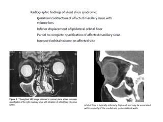 orbital floor is typically inferiorly displaced and may be associated
with concavity of the medial and posterolateral walls
 