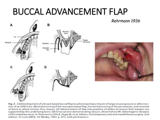 BUCCAL ADVANCEMENT FLAP
Rehrmann 1936
 