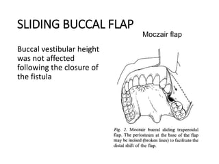 SLIDING BUCCAL FLAP
Buccal vestibular height
was not affected
following the closure of
the fistula
Moczair flap
 
