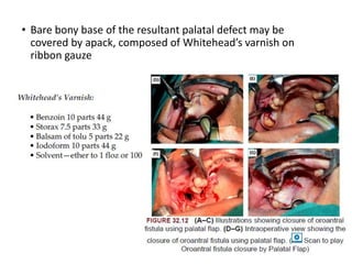 • Bare bony base of the resultant palatal defect may be
covered by apack, composed of Whitehead’s varnish on
ribbon gauze
 