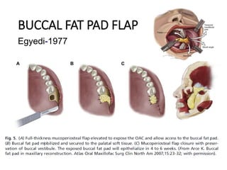 BUCCAL FAT PAD FLAP
Egyedi-1977
 