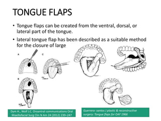 TONGUE FLAPS
• Tongue flaps can be created from the ventral, dorsal, or
lateral part of the tongue.
• lateral tongue flap has been described as a suitable method
for the closure of large
Dym H., Wolf J.C. Oroantral communications Oral
Maxillofacial Surg Clin N Am 24 (2012) 239–247
Guerrero- santos J plastic & reconstructive
surgery: Tongue flaps for OAF 1966
 