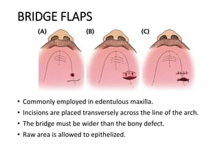 BRIDGE FLAPS
• Commonly employed in edentulous maxilla.
• Incisions are placed transversely across the line of the arch.
• The bridge must be wider than the bony defect.
• Raw area is allowed to epithelized.
 