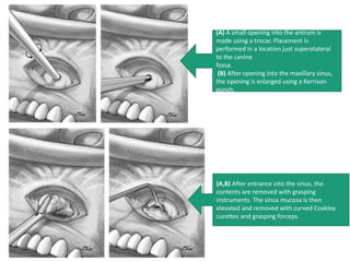 (A,B) After entrance into the sinus, the
contents are removed with grasping
instruments. The sinus mucosa is then
elevated and removed with curved Coakley
curettes and grasping forceps.
(A) A small opening into the antrum is
made using a trocar. Placement is
performed in a location just superolateral
to the canine
fossa.
(B) After opening into the maxillary sinus,
the opening is enlarged using a Kerrison
punch.
 