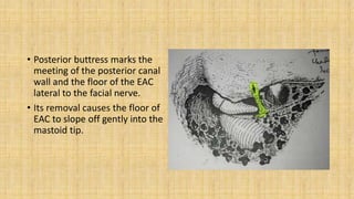 • Posterior buttress marks the
meeting of the posterior canal
wall and the floor of the EAC
lateral to the facial nerve.
• Its removal causes the floor of
EAC to slope off gently into the
mastoid tip.
 