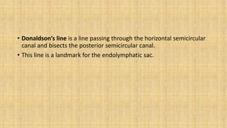 • Donaldson’s line is a line passing through the horizontal semicircular
canal and bisects the posterior semicircular canal.
• This line is a landmark for the endolymphatic sac.
 