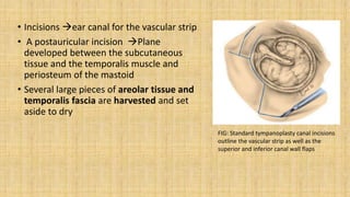 • Incisions ear canal for the vascular strip
• A postauricular incision Plane
developed between the subcutaneous
tissue and the temporalis muscle and
periosteum of the mastoid
• Several large pieces of areolar tissue and
temporalis fascia are harvested and set
aside to dry
FIG: Standard tympanoplasty canal incisions
outline the vascular strip as well as the
superior and inferior canal wall flaps
 