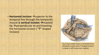 • Horizontal incision superior to the
temporal line through the temporalis
muscle & vertical incision mastoid
tip perpendicular to and bisecting
the horizontal incision ( “T” shaped
Incision)
Fig: Loose areolar fascia is harvested from
temporal muscle, and a T-shaped incision
is made in soft tissue over mastoid.
 