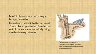 • Mastoid bone is exposed using a
Lempert elevator
• Periosteum raised into the ear canal
vascular strip elevated & reflected
out of the ear canal anteriorly using
a self-retaining retractor
Fig:Exposure of mastoid in
crosssection showing vascular
strip held forward under anterior
blade of retractor.
 