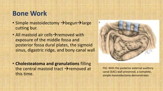 Bone Work
• Simple mastoidectomy begunlarge
cutting bur.
• All mastoid air cellsremoved with
exposure of the middle fossa and
posterior fossa dural plates, the sigmoid
sinus, digastric ridge, and bony canal wall
• Cholesteatoma and granulations filling
the central mastoid tract removed at
this time.
FIG: With the posterior external auditory
canal (EAC) wall preserved, a complete,
simple mastoidectomy demonstrates
 