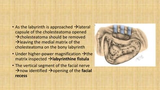 • As the labyrinth is approached lateral
capsule of the cholesteatoma opened
cholesteatoma should be removed
leaving the medial matrix of the
cholesteatoma on the bony labyrinth
• Under higher-power magnification the
matrix inspected labyrinthine fistula
• The vertical segment of the facial nerve
now identified opening of the facial
recess
 