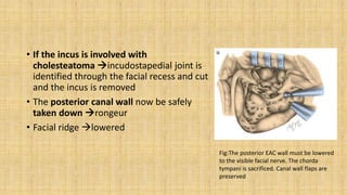 • If the incus is involved with
cholesteatoma incudostapedial joint is
identified through the facial recess and cut
and the incus is removed
• The posterior canal wall now be safely
taken down rongeur
• Facial ridge lowered
Fig:The posterior EAC wall must be lowered
to the visible facial nerve. The chorda
tympani is sacrificed. Canal wall flaps are
preserved
 