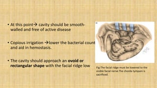 • At this point cavity should be smooth-
walled and free of active disease
• Copious irrigation lower the bacterial count
and aid in hemostasis.
• The cavity should approach an ovoid or
rectangular shape with the facial ridge low Fig:The facial ridge must be lowered to the
visible facial nerve.The chorda tympani is
sacrificed.
 