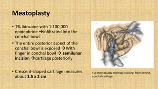 Meatoplasty
• 1% lidocaine with 1:100,000
epinephrine infiltrated into the
conchal bowl
• The entire posterior aspect of the
conchal bowl is exposed With
finger in conchal bowl  semilunar
incision cartilage posteriorly
• Crescent-shaped cartilage measures
about 1.5 x 2 cm
Fig: meatoplasty beginsby excising, from behind,
conchal cartilage
 