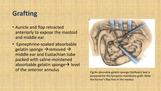Grafting
• Auricle and flap retracted
anteriorly to expose the mastoid
and middle ear
• Epinephrine-soaked absorbable
gelatin sponge removed 
middle ear and Eustachian tube
packed with saline-moistened
absorbable gelatin sponge level
of the anterior annulus Fig:An absorable gelatin sponge (Gelfoam) bed is
prepared for the tympanic membrane graft. Note
the Korner's flap free in the meatus
 