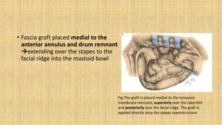 • Fascia graft placed medial to the
anterior annulus and drum remnant
extending over the stapes to the
facial ridge into the mastoid bowl
Fig:The graft is placed medial to the tympanic
membrane remnant, superiorly over the labyrinth
and posteriorly over the facial ridge. The graft is
applied directly atop the stapes superstructure
 