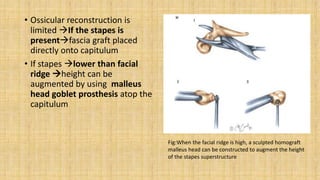 • Ossicular reconstruction is
limited If the stapes is
presentfascia graft placed
directly onto capitulum
• If stapes lower than facial
ridge height can be
augmented by using malleus
head goblet prosthesis atop the
capitulum
Fig:When the facial ridge is high, a sculpted homograft
malleus head can be constructed to augment the height
of the stapes superstructure
 