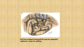 Fig:The sculpted homograft fits atop the stapedial
capitulum, ready for grafting
 