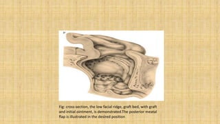 Fig: cross-section, the low facial ridge, graft bed, with graft
and initial ointment, is demonstrated.The posterior meatal
flap is illustrated in the desired position
 