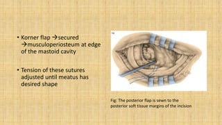 • Korner flap secured
musculoperiosteum at edge
of the mastoid cavity
• Tension of these sutures
adjusted until meatus has
desired shape
Fig: The posterior flap is sewn to the
posterior soft tissue margins of the incision
 