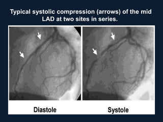 Typical systolic compression (arrows) of the mid
LAD at two sites in series.
 