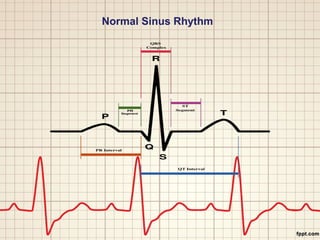 Normal Sinus Rhythm 
 