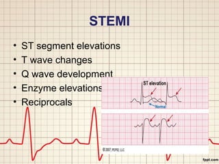 STEMI 
• ST segment elevations 
• T wave changes 
• Q wave development 
• Enzyme elevations 
• Reciprocals 
 