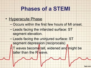 Phases of a STEMI 
• Hyperacute Phase 
– Occurs within the first few hours of MI onset. 
– Leads facing the infarcted surface: ST 
segment elevation. 
– Leads facing the uninjured surface: ST 
segment depression (reciprocals) 
– T waves become tall, widened and might be 
taller than the R wave. 
 