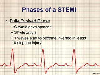 Phases of a STEMI 
• Fully Evolved Phase 
– Q wave development 
– ST elevation 
– T waves start to become inverted in leads 
facing the injury. 
 