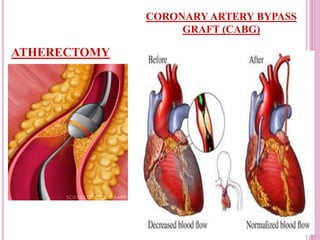 ATHERECTOMY
CORONARY ARTERY BYPASS
GRAFT (CABG)
 