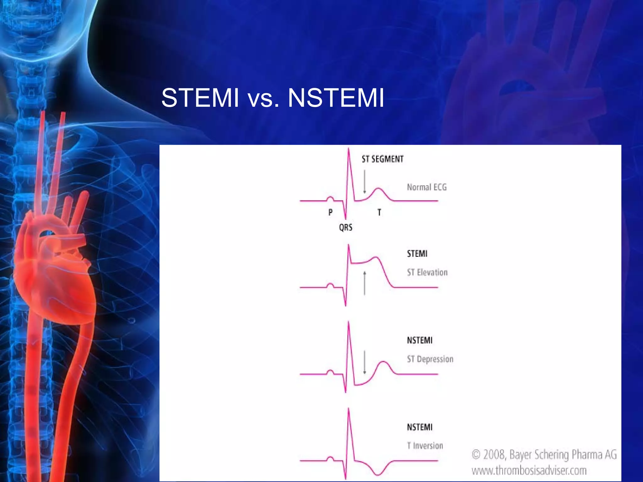 Myocardial infarction | PPT