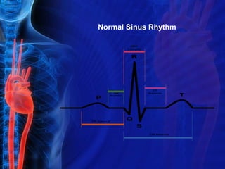 Normal Sinus Rhythm
 