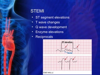 STEMI
• ST segment elevations
• T wave changes
• Q wave development
• Enzyme elevations
• Reciprocals
 