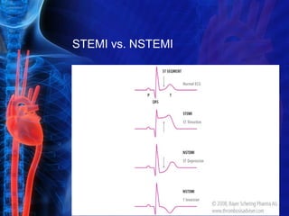 STEMI vs. NSTEMI
 