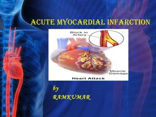 Acute MyocArdiAl infArction
by
RAMKUMAR
 