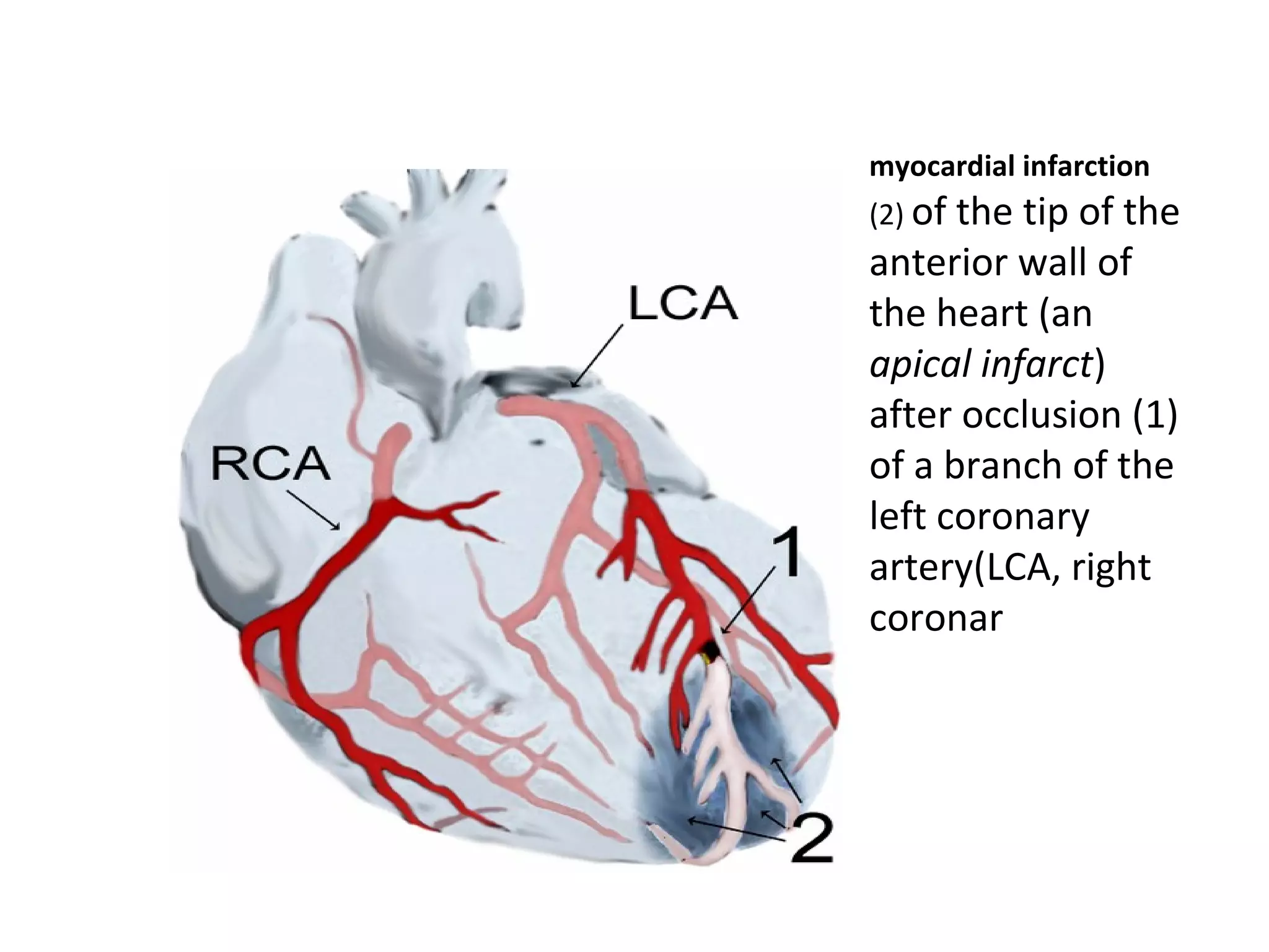 Myocardial infarction | PPT