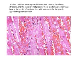 1-2days This is an acute myocardial infarction. There is loss of cross
striations, and the nuclei are not present. There is extensive hemorrhage
here at the border of the infarction, which accounts for the grossly
apparent hyperemic border.
 