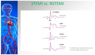 Myocardial infarction | PPTX